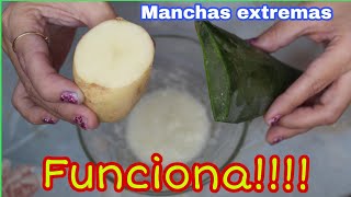 COMO QUITAR MANCHAS DE TU CARA EXTREMAS REMEDIO CASERO PARA MANCHAS [upl. by Nelleh285]