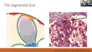 Focal Segmental Glomerulosclerosis FSGS [upl. by Rma]