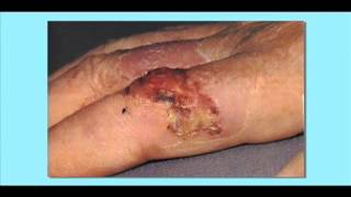 Squamous Cell Carcinoma Skin Cancer [upl. by Pulchia]