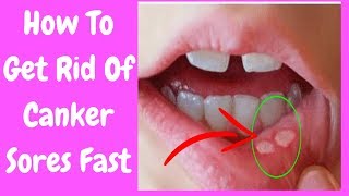 How to Get rid of Canker Sores Fast  Can You Get a Canker Sore on Your Tongue [upl. by Duthie990]