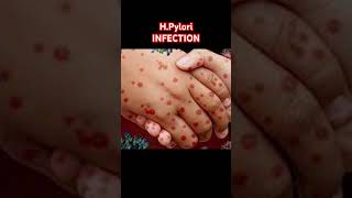 🦠 HPylori Infection Explained 😷 stomach infection shorts [upl. by Biddick]