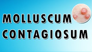 Molluscum Contagiosum Symptoms and Treatment [upl. by Yramesor832]