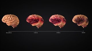 Traumatic Brain Injury Timeline Animation Charts Encephalomalacia [upl. by Atinuahs]