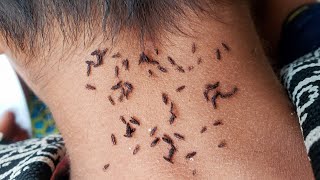 Getting out all hundred lice from short hair  Remove thousand lice from short hair [upl. by Melbourne]