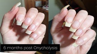 Onycholysis Update 6 Months Later [upl. by Kcitrap]