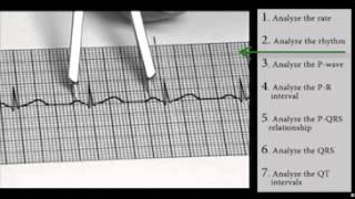 EKG Interpretation and Response SERIES Sinus Dysrhythmias [upl. by Notle]