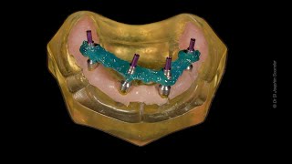 StepbyStep Allon4 Impression Techinique allonX allon4 allon6 fullmouth zygomaticimplants [upl. by Ltihcox]