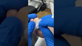 Watch a Podiatrist Expertly Remove a Big Toe Callus with Scalpel [upl. by Htebazie]