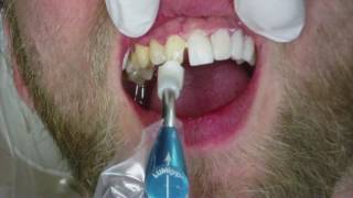 Veneers Dental Procedure at Cosmetic Dental Associates in San Antonio TX [upl. by Lebbie]