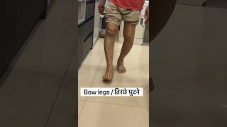 Bow legs from arthritishow to fix it kneereplacementoperation bowlegs osteoarthritis [upl. by Ynar]