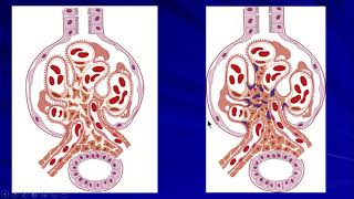 21 IgA nephropathy [upl. by Zandt]