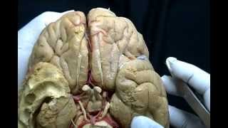 NEUROANATOMÍA 20 DISECCIÓN DE LA CARA VENTRAL DEL ENCÉFALO LÓBULO TEMPORAL 1 [upl. by Nesbitt171]