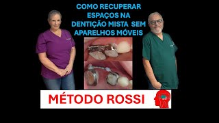 Como recuperar espaços na dentição mista sem aparelhos móveis [upl. by Darsey]