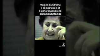 meige s syndrome combination of blepharospasm and orofacial dystonia [upl. by Onitnevuj]