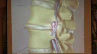 Lumbar Spinal Stenosis Part 2  Treatment Options Paul Houle MD [upl. by Yengac]