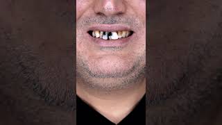 veneers smilemakeoverturkey cosmeticdentistry hollywoodsmileturkey cosmeticsurgery dentist [upl. by Ander64]