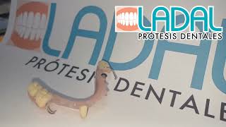 Prótesis Dental parcial inferior con barra lingual [upl. by Thanh907]