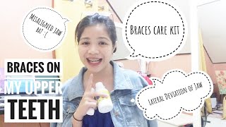 VLOG 3  TMD  Orthodontic Braces on Upper Teeth  Braces Kit  Lateral Deviation and Deflection [upl. by Moffat544]