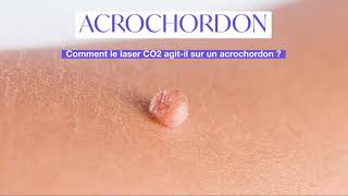 Acrochordons Excroissance de Peau  comment sen débarrasser   Skin Marceau Paris [upl. by Amian]