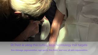 IPL on Hands amp Arms Treatment with Dr Jennifer Trent [upl. by Nallek]