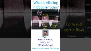 What is Aliasing in Doppler Echo [upl. by Smitty]