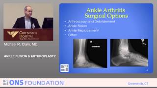 Ankle Fusion and Arthroplasty by Michael Clain MD [upl. by Coffin]