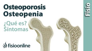 Osteoporosis y osteopenia  Qué es causas síntomas y tratamiento [upl. by Pontus]