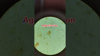 Cross match blood reaction when two different blood samples mixsimple way of cross match [upl. by Flodnar]