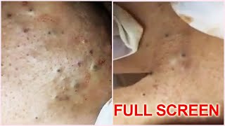 5 Years Old Blackheads Removal  Best Pimple Popping Videos [upl. by Aedni]