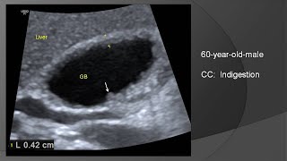 Adenomyomatosis of gallbladder [upl. by Nyleuqaj]