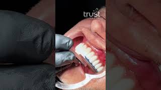 Transforming Lives Zirconia prostheses Dental implants [upl. by Norred]