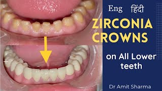 How teeth capping is done  zirconia crowns  Dental crowns  कैपिंग कैसे की जाती है [upl. by Hairakcaz550]