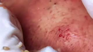 Ep6 Get Rid of Acne FAST with this Treatment 2024 [upl. by Pollyanna569]