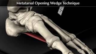 Hallux Valgus Correction with Bunionectomy Lateral Release and Proximal Opening Wedge Osteotomy [upl. by Nikola]