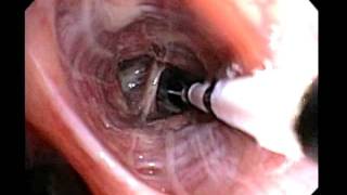 Bronchial Thermoplasty Improved Asthma Control for your Patients [upl. by Remsen]