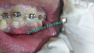 Oral benign asymptomatic prolonged irritation fibroma caused by cheek biting rubbing from teeth [upl. by Noval]