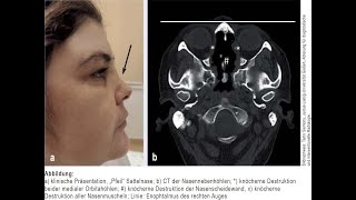 Orbitabodenbeteiligung bei Granulomatose mit Polyangiitis [upl. by Rubbico]