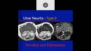 Elbow Part 7 Elbow Nerves [upl. by Cressida]