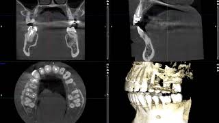 Buccal Exostosis [upl. by Kory]