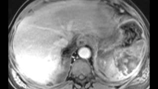 Splenic Infarct [upl. by Chung]