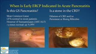 Management of Acute Pancreatitis [upl. by Krysta]