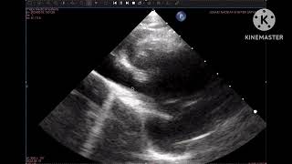 Sinus Venosus ASD SVC type with explanation [upl. by Gnas214]