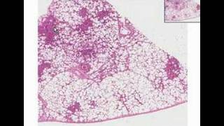 Histopathology LungBronchopneumonia [upl. by Nora]