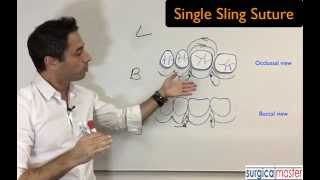 How to perform a sling suture [upl. by Eiralav]