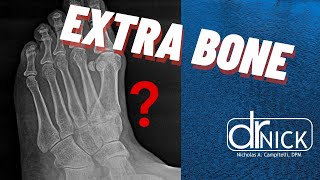 Extra bone in your foot The accessory navicular bone  Dr Nick [upl. by Dania]