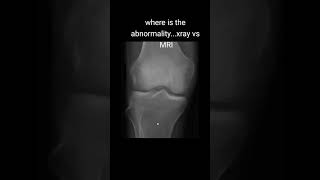 radiology التشخيصالطبي medicalconsultation radiologylife fracture [upl. by Holleran]