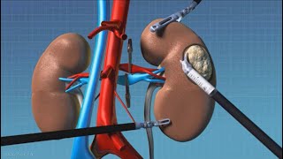 Tumorectomia renale  la RAPN Robotic Assisted Partial Nephrectomy [upl. by Ardine]