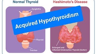 Chronic lymphocytic thyroiditis Hashimoto Thyroiditis or Autoimmune Thyroiditis [upl. by Lissak233]