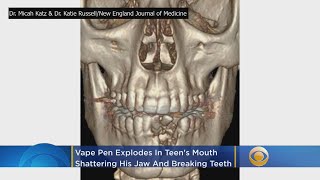 Vape Pen Explodes In Teens Mouth Shattering His Jaw [upl. by Litnahc]