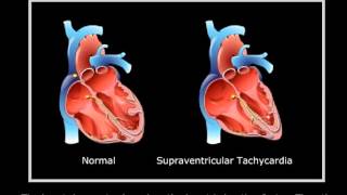 Supraventricular tachycardia [upl. by Nhojleahcim]